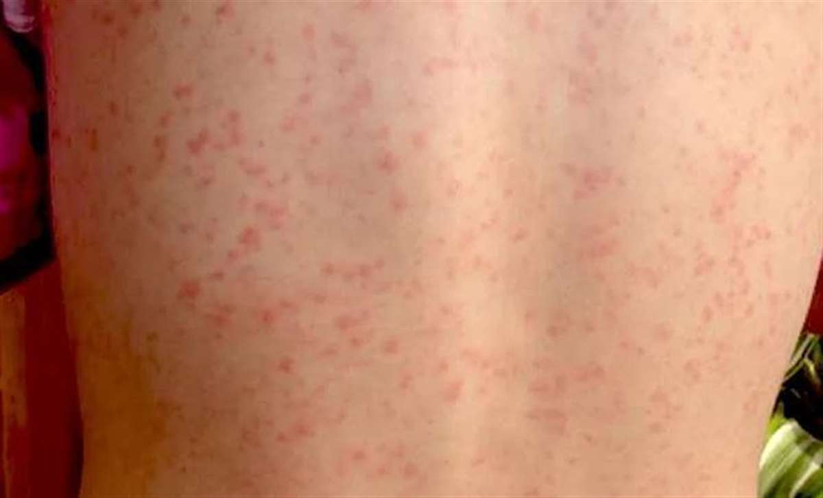 Daily Record - An outbreak of Scarlet Fever in Scotland has prompted health  professionals to issue urgent advice to the public as cases continue to  rise. ⚠️ The victorian disease is said